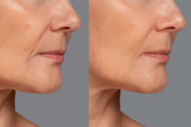 Ulthera ก่อนหลัง