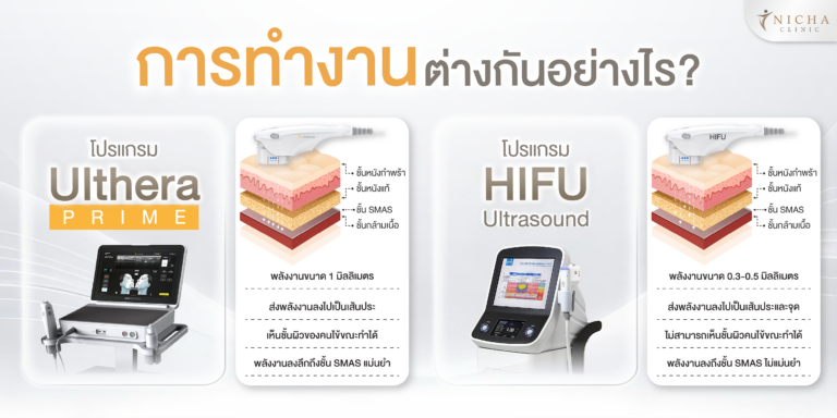 อินโฟกราฟิกเปรียบเทียบการทำงานของ Ulthera Prime และ HIFU แสดงความแตกต่างด้านขนาดจุดพลังงาน ความสามารถในการมองเห็นชั้นผิว และความแม่นยำในการส่งพลังงานถึงชั้น SMAS